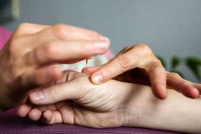 acupuncture needle inserted into patients hand
