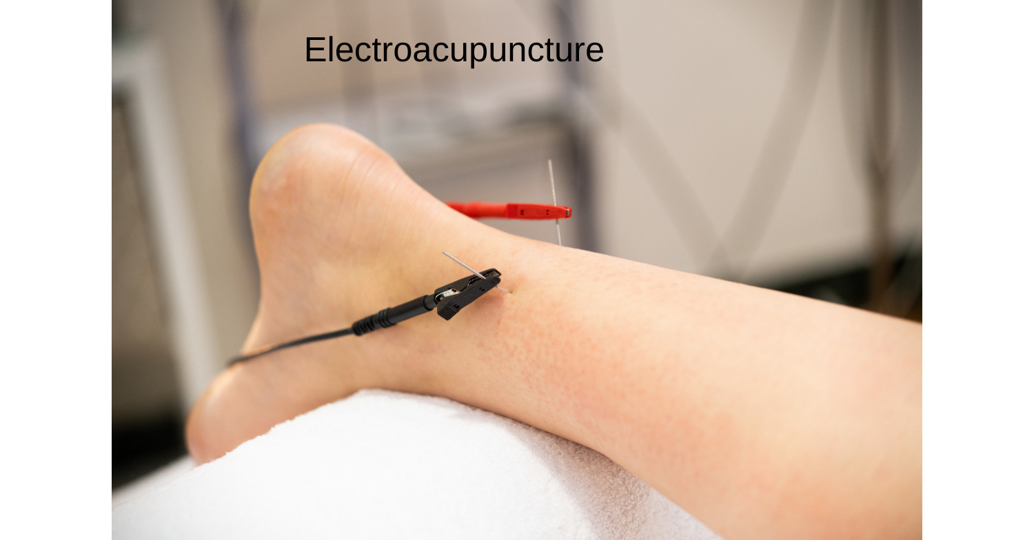 a person receiving electroacupuncture on their ankle