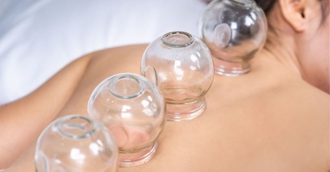 Cupping Therapy