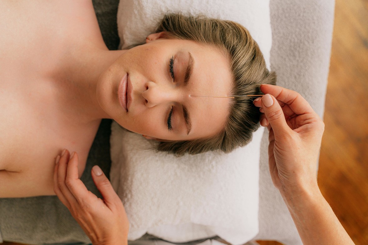 woman receiving acupuncture